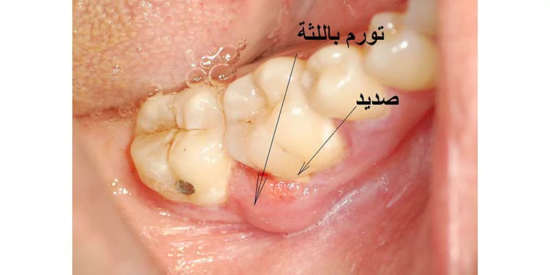 شكل صديد الاسنان