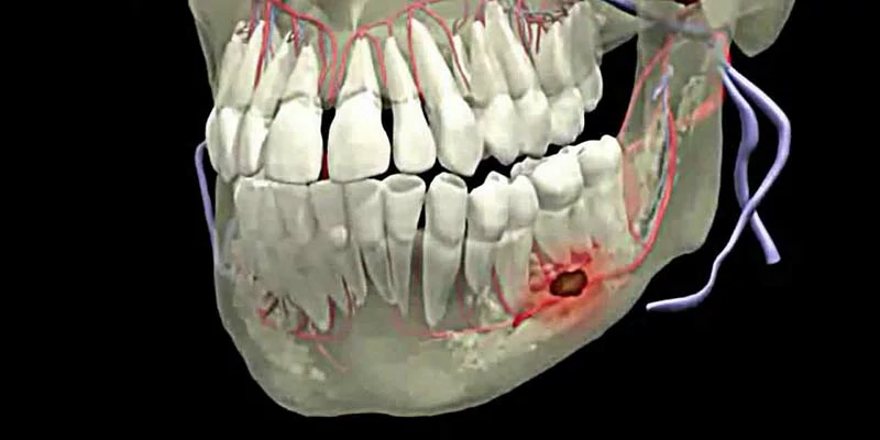 علاج الضرس المحشو