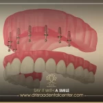 تركيب الأسنان المتحركة – أشهر 4 أنواع ومزايا وعيوب كل نوع