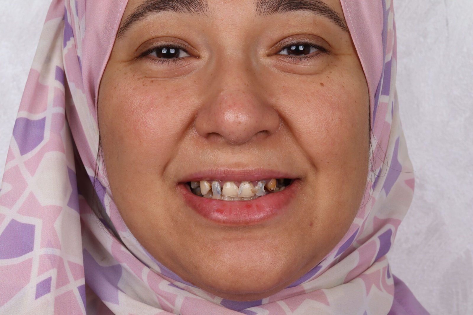 الفينير 3 IMG 0008 scaled