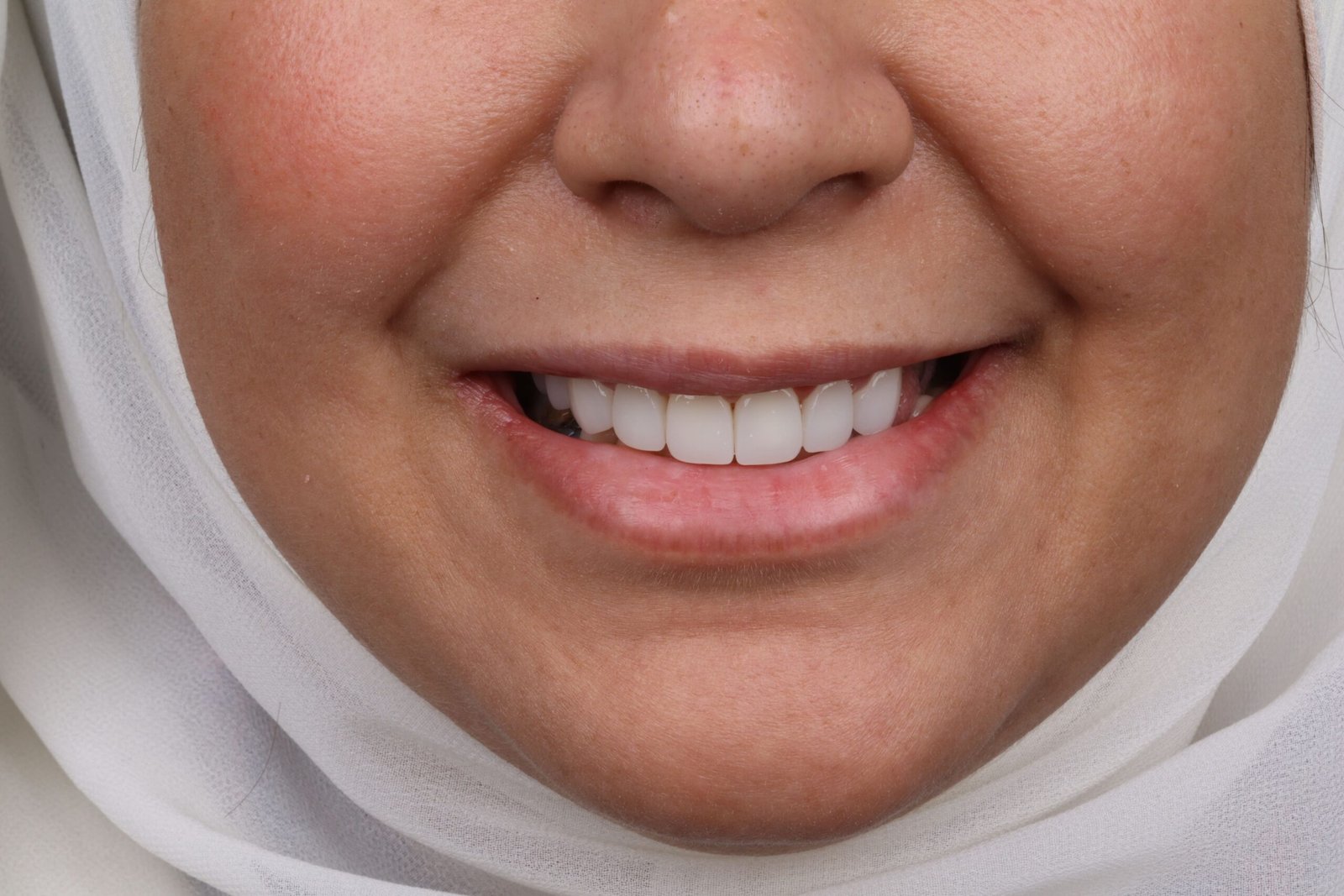 الفينير 4 IMG 0136 scaled