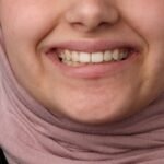 تبييض الأسنان 5 IMG 0142