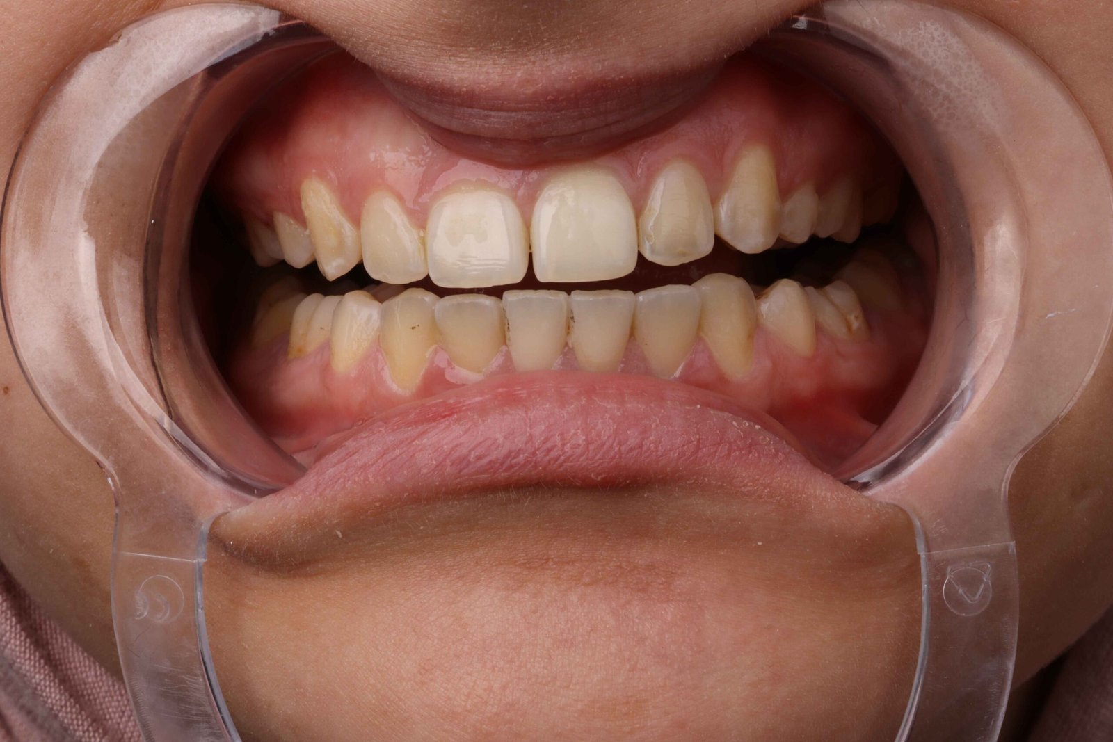 تبييض الأسنان 3 IMG 0145 scaled