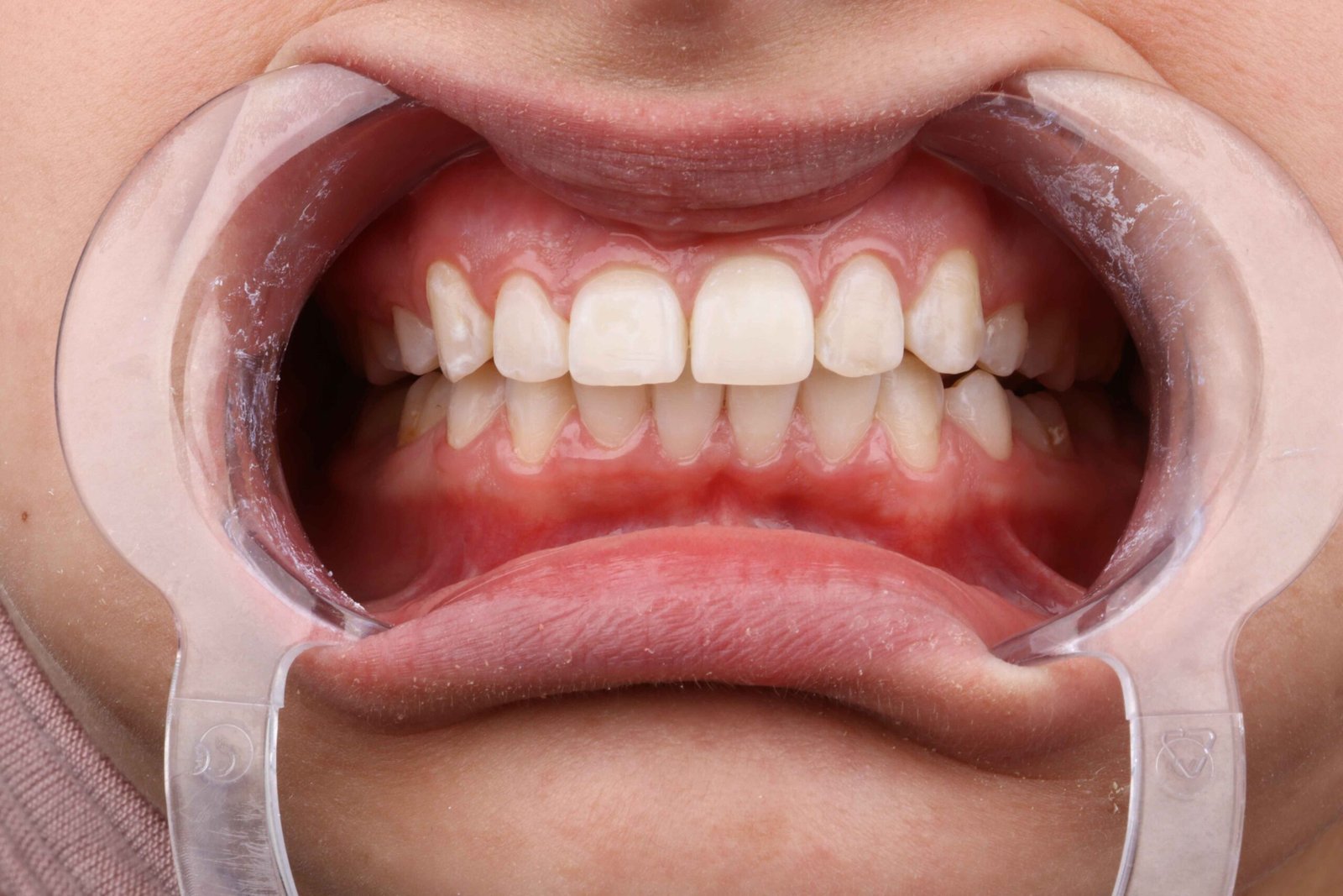 تبييض الأسنان 4 IMG 0149 scaled