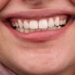 تبييض الأسنان 6 IMG 0150