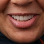 الفينير 5 IMG 0182