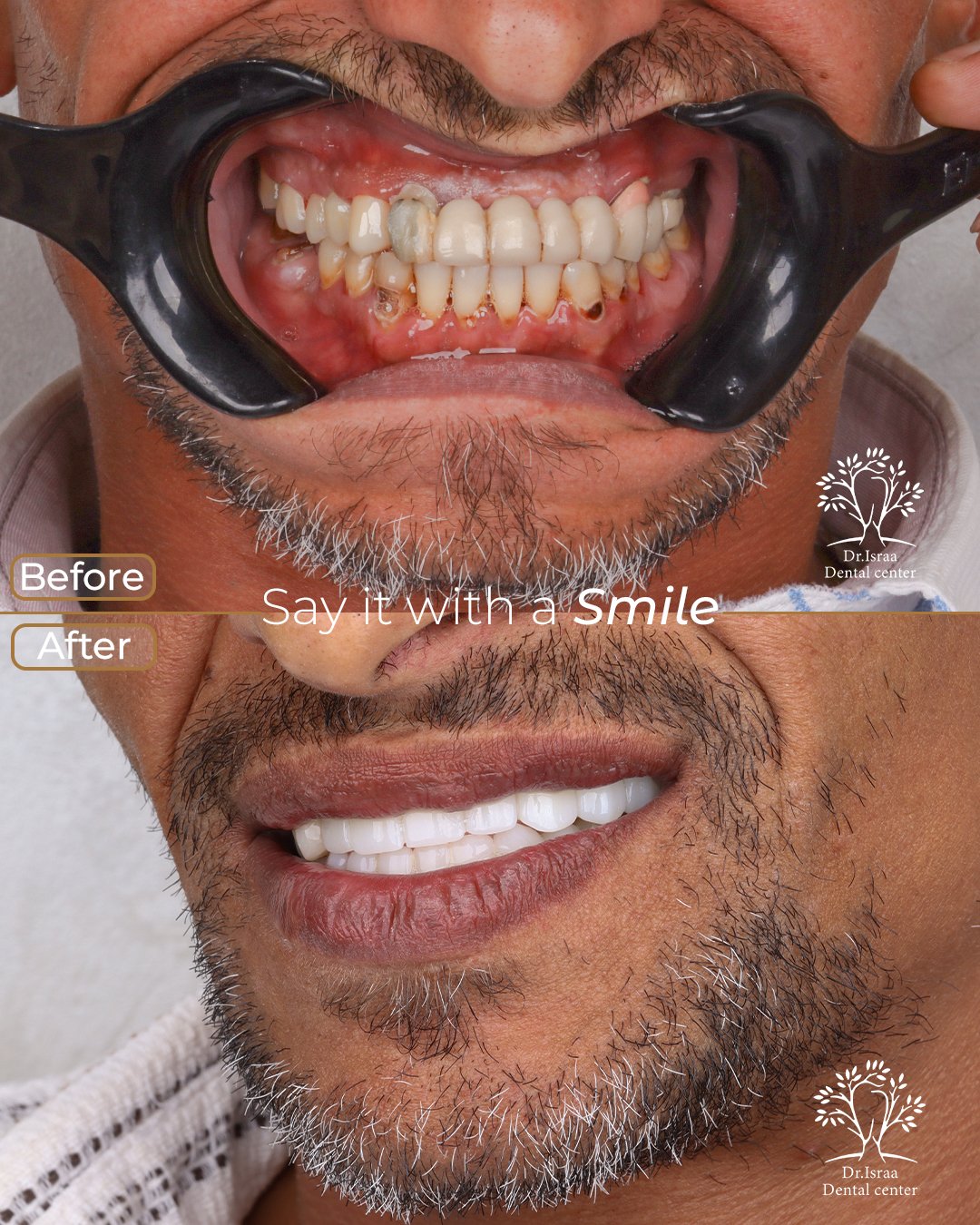 hatem mohamed tawfik implants full mouth