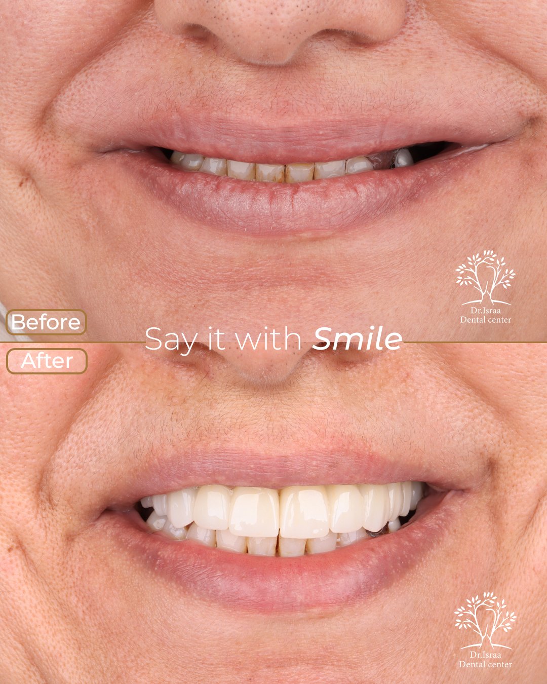 hemat mostafa 1 implant