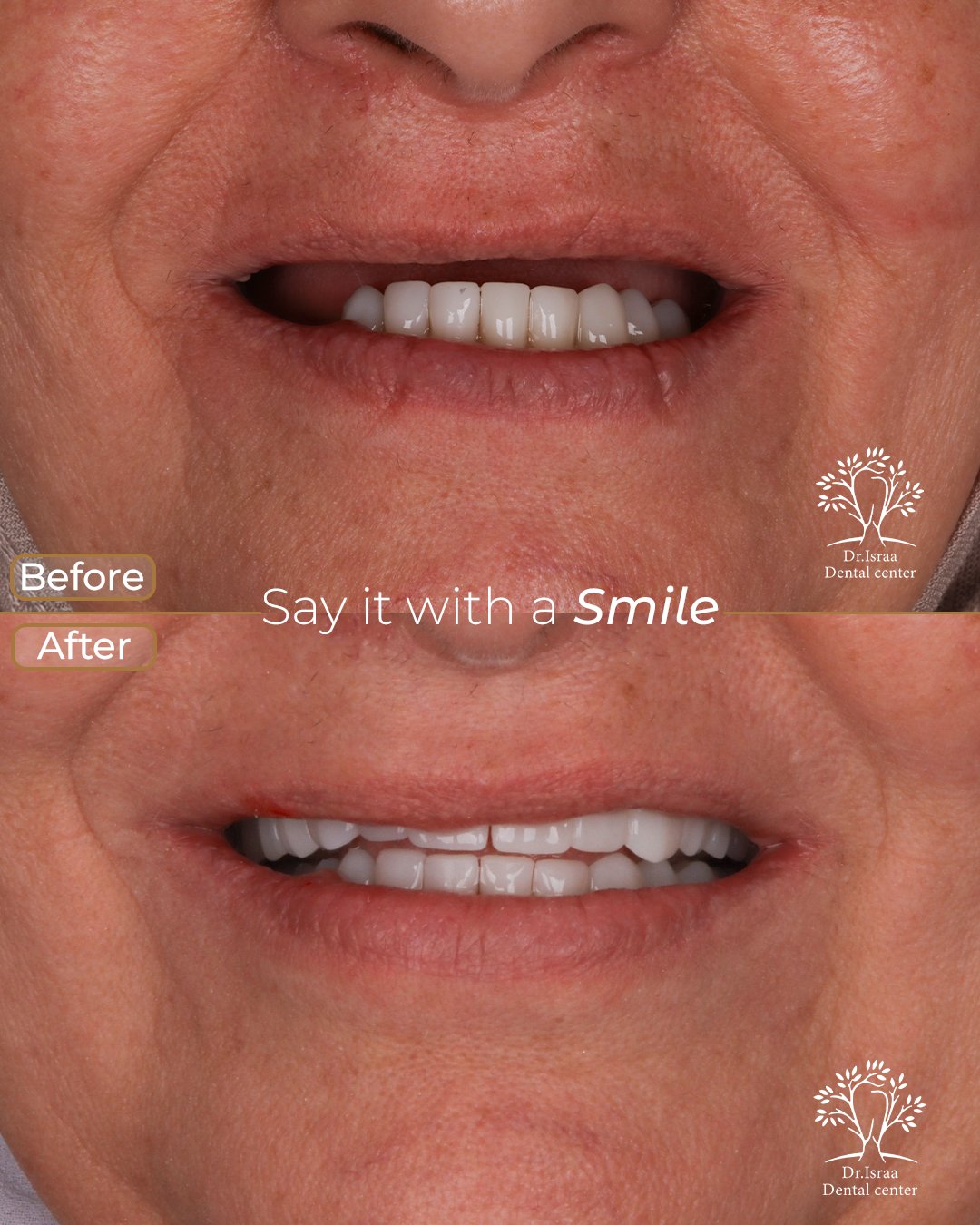 mervat mahmoud masry implant