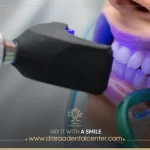 تنظيف الأسنان بالليزر ـ أفضل الطرق للحصول على أسنان ناصعة البياض