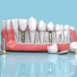 هل يمكن زراعة الاسنان لمرضى السكر؟