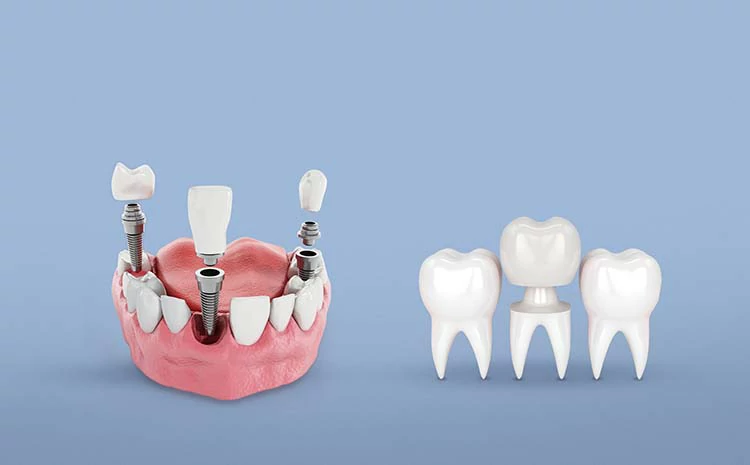 الفرق بين زراعة الاسنان وتركيب الاسنان