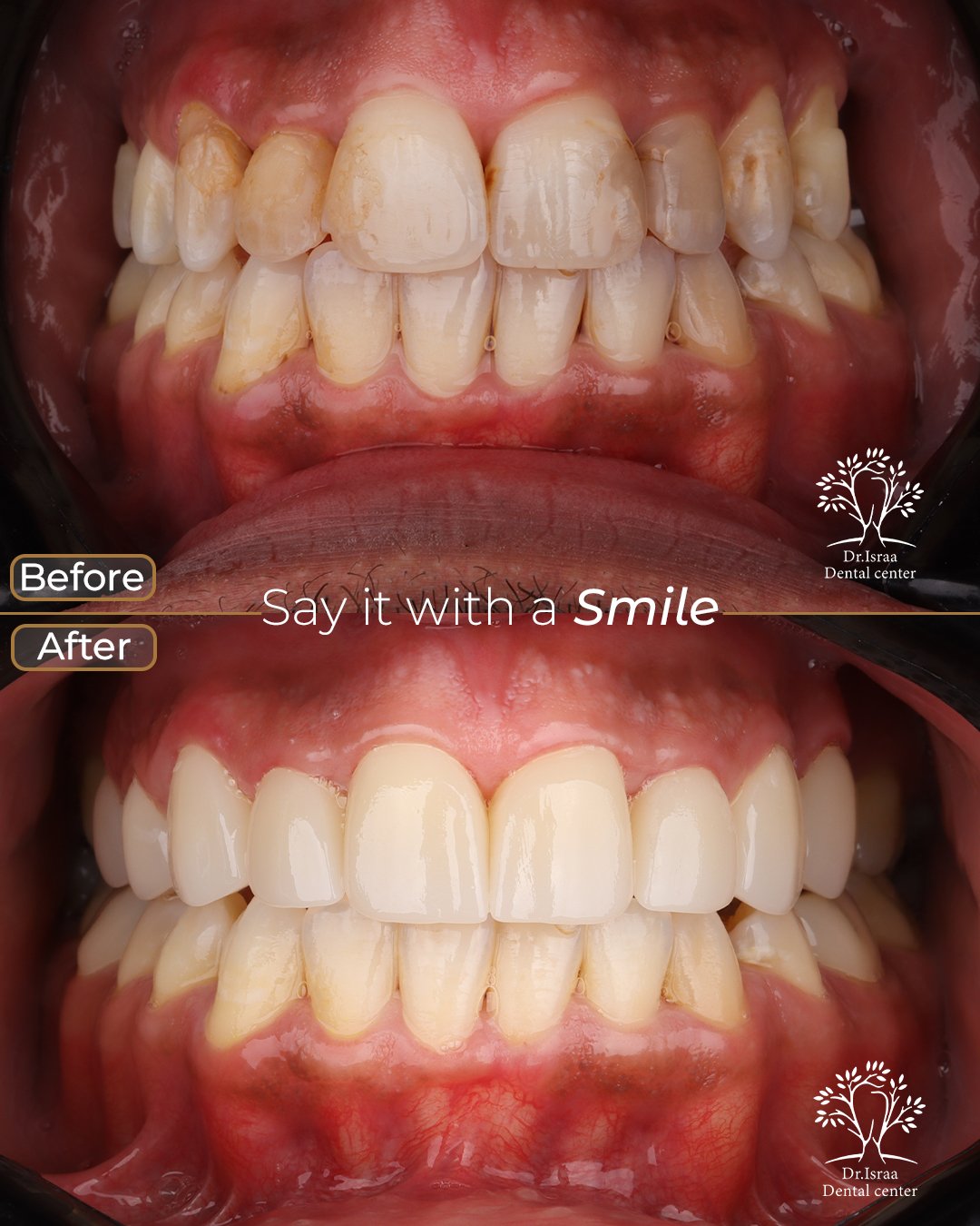 الفينير 6 abdel mohsen al amody 1 crowns