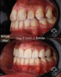 الفينير 7 abdel mohsen al amody 2 crowns