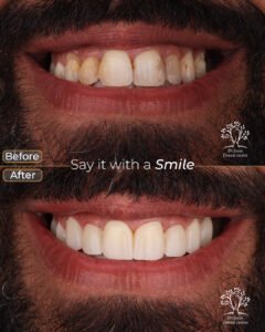 الفينير 8 abdel mohsen al amody crowns