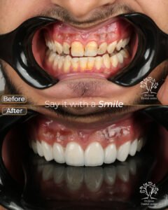 الفينير 10 male 2 2