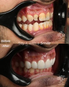 الفينير 11 male 2 3