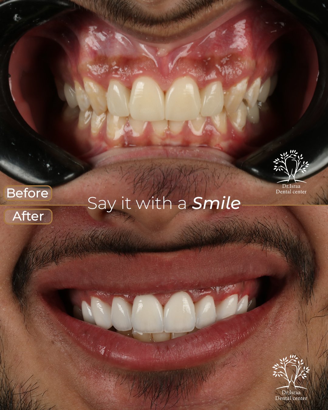 الفينير 12 male 3 1