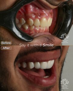 الفينير 13 male 3 2