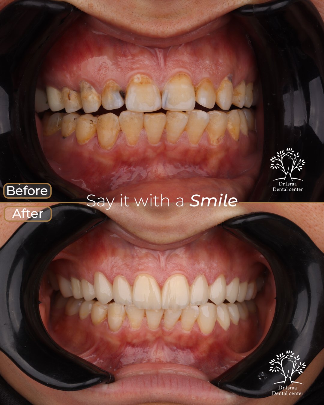 الفينير 14 rana elham mohamed 2 veneers