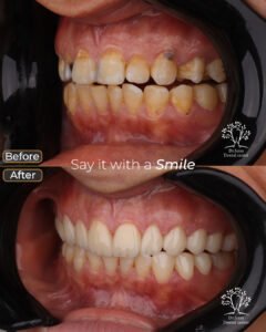 الفينير 15 rana elham mohamed 3 veneers