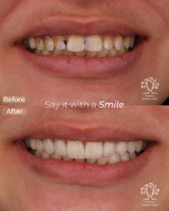 الفينير 16 rana elham mohamed veneers