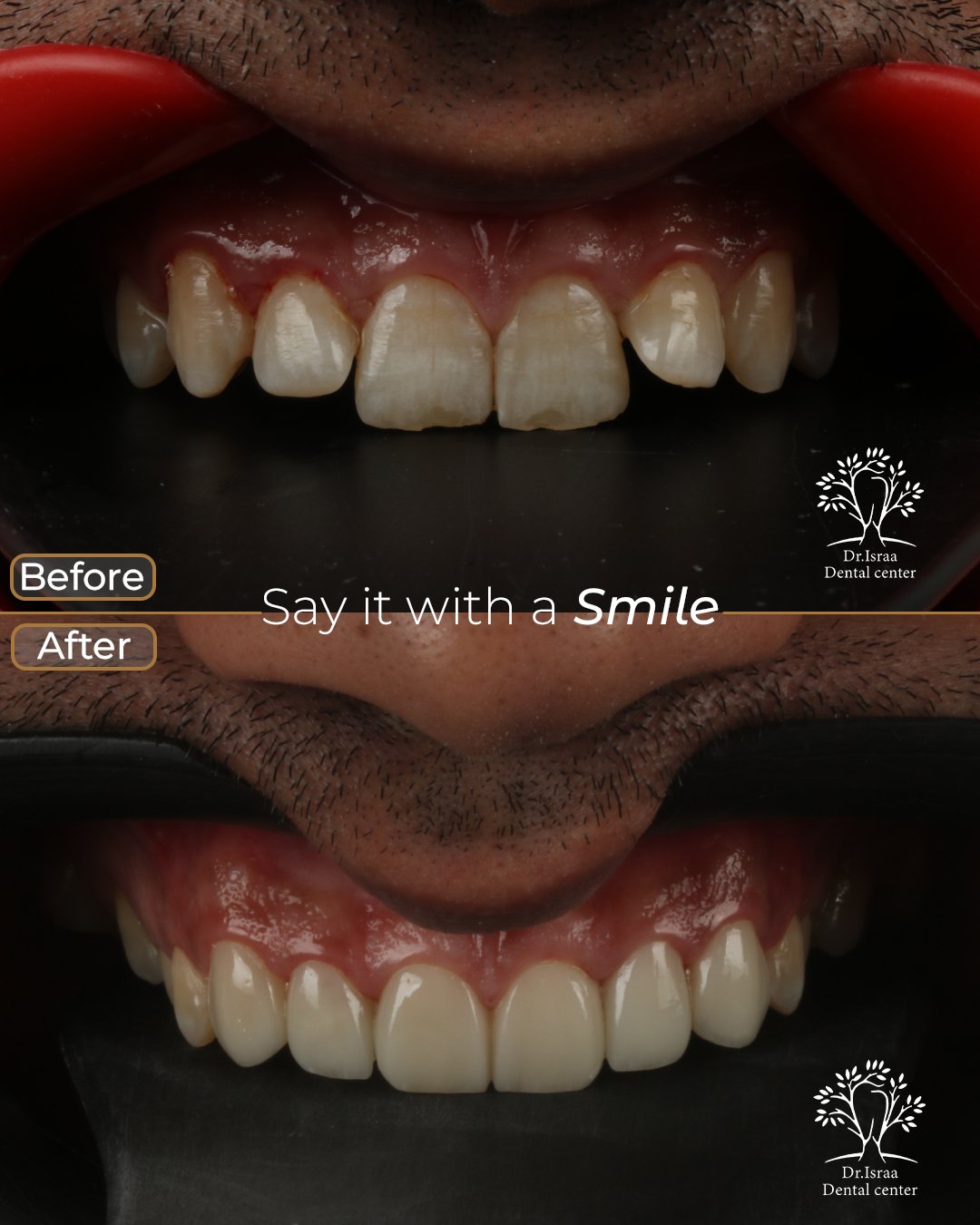 الفينير 17 ابراهيم مليجي 1