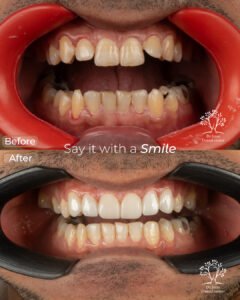 الفينير 18 ابراهيم مليجي 3