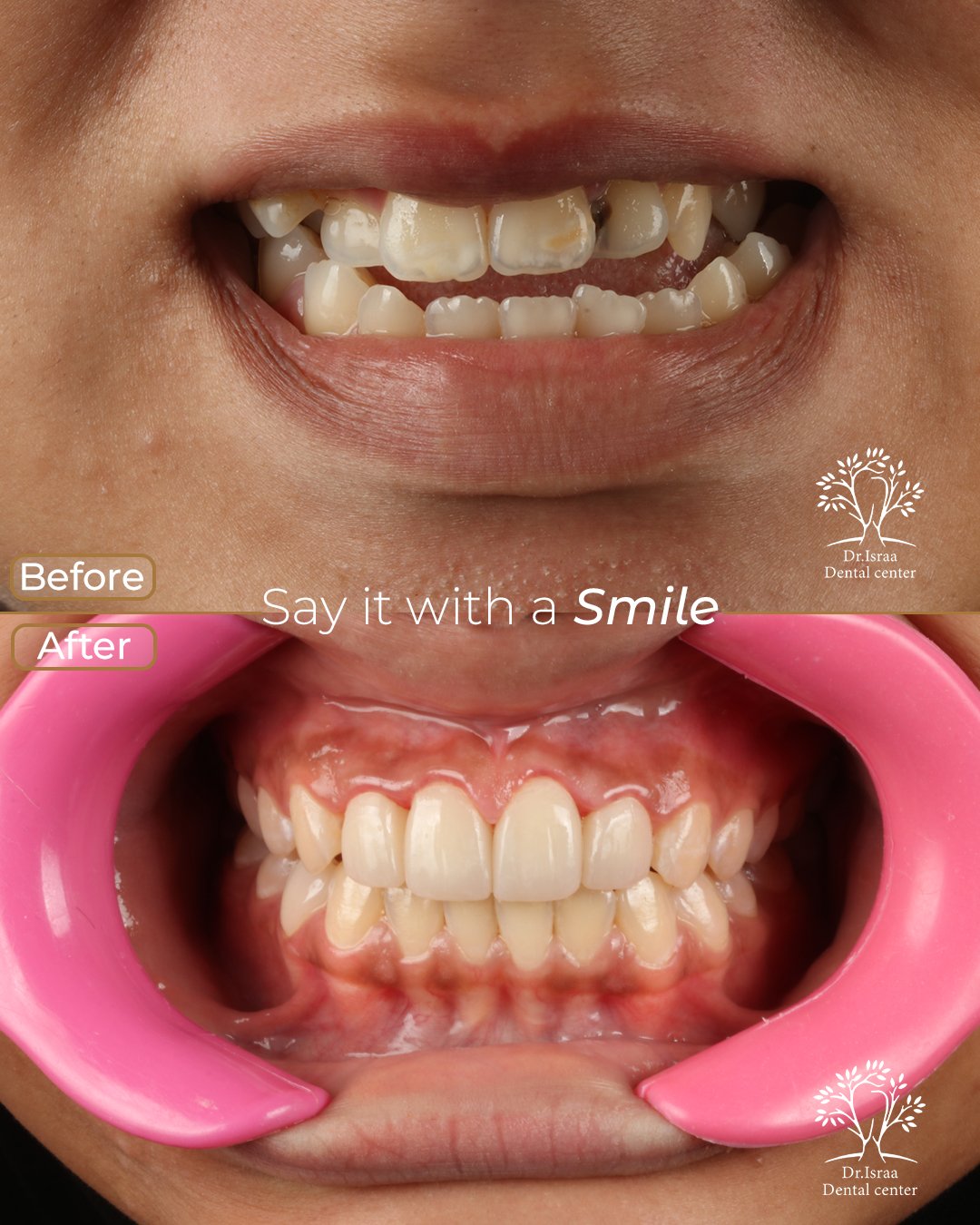 الفينير 19 اسراء مرعي بعد 1