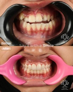 الفينير 20 اسراء مرعي بعد 2