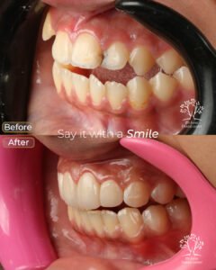 الفينير 21 اسراء مرعي بعد 3