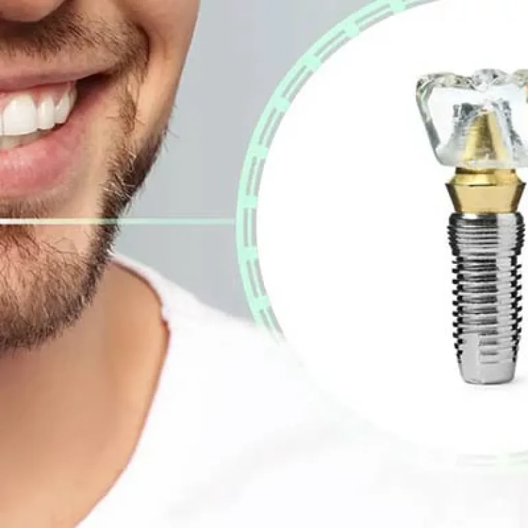 أضرار زراعة الاسنان