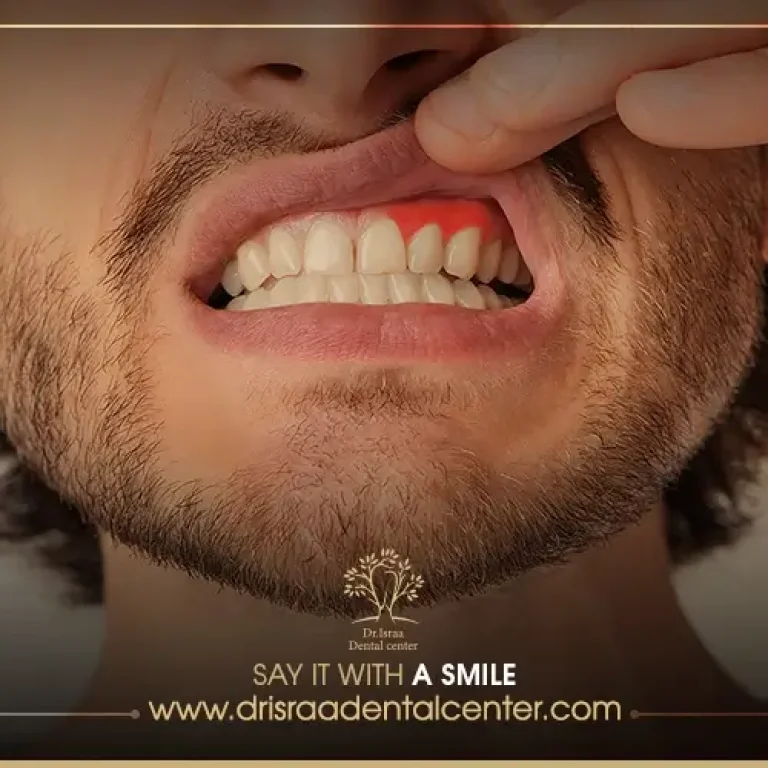 أفضل علاج لالتهاب اللثة الحاد