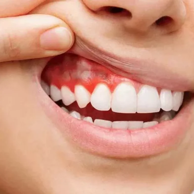 أنواع التهاب اللثة بالصور