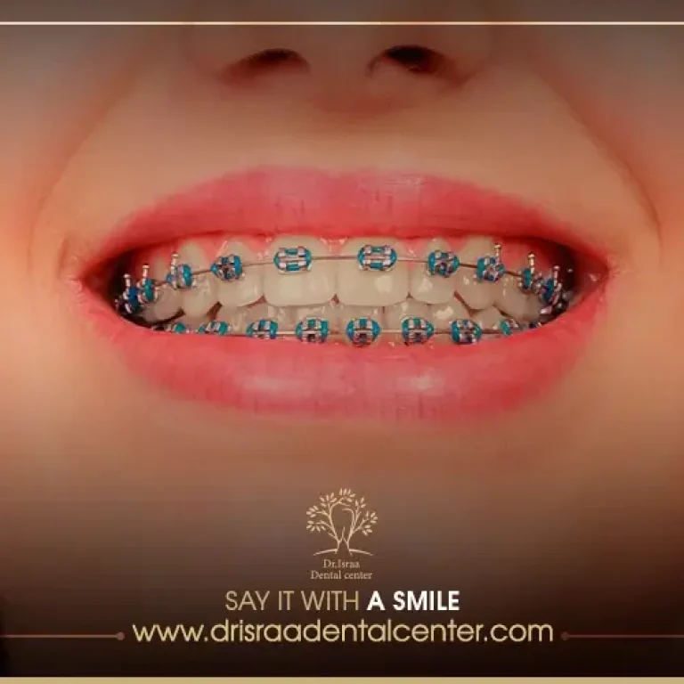 أنواع تقويم الأسنان