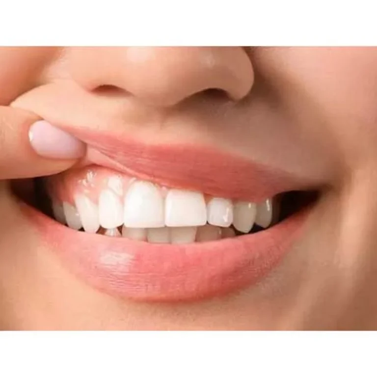 اسباب خراج اللثة