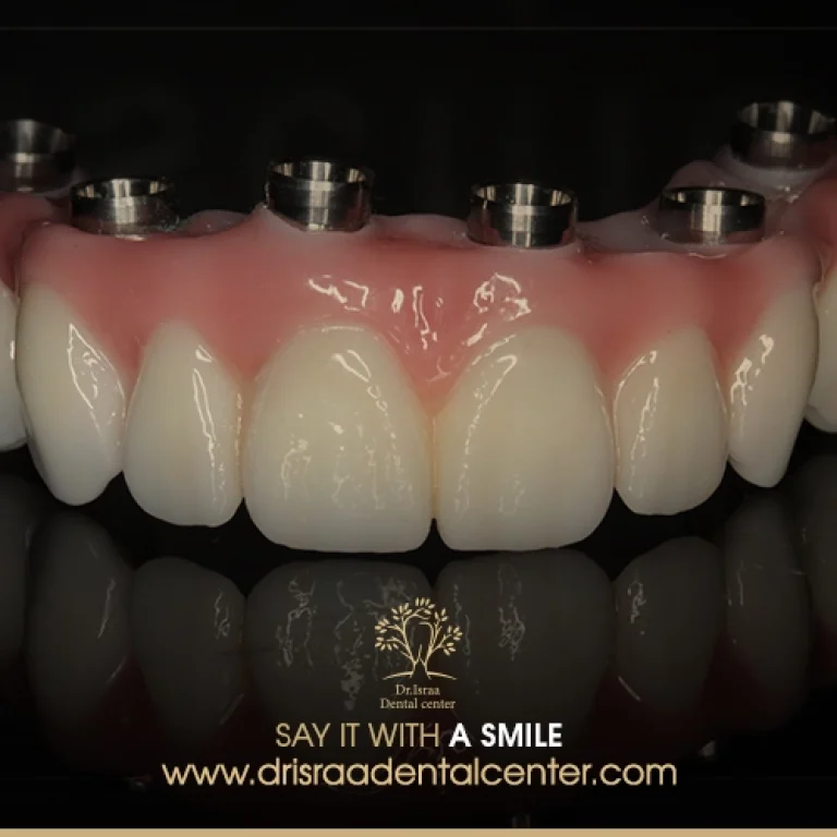 اسعار تركيب الاسنان الزيركون في مصر