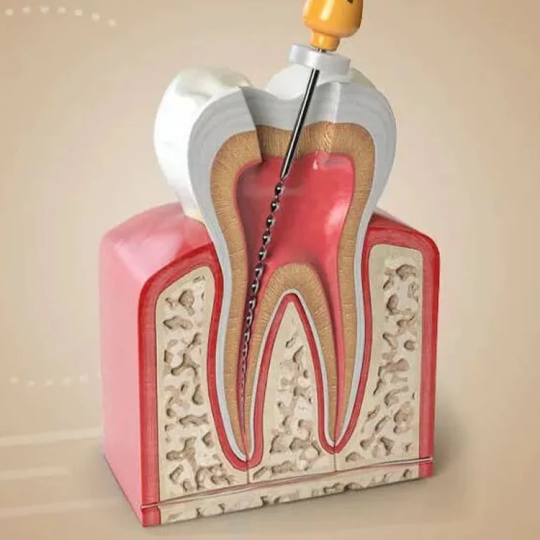 اسعار حشو العصب