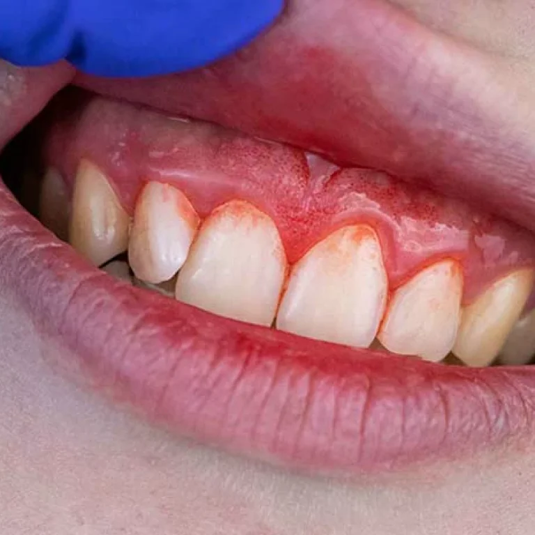 التهاب اللثة