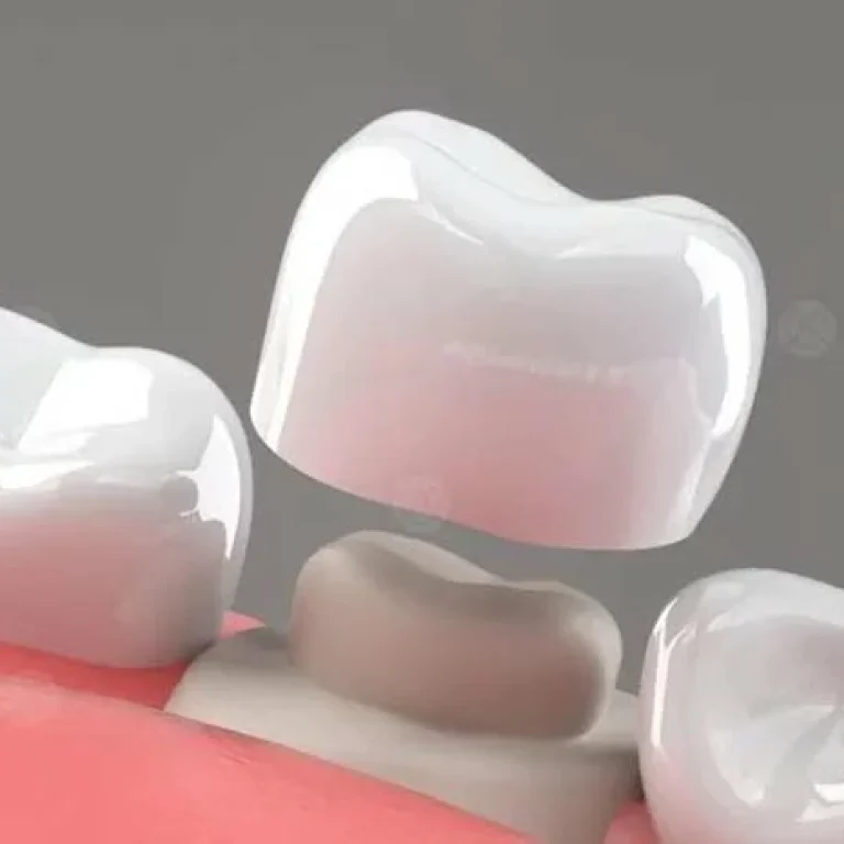 التهاب اللثة بعد تركيب الطربوش