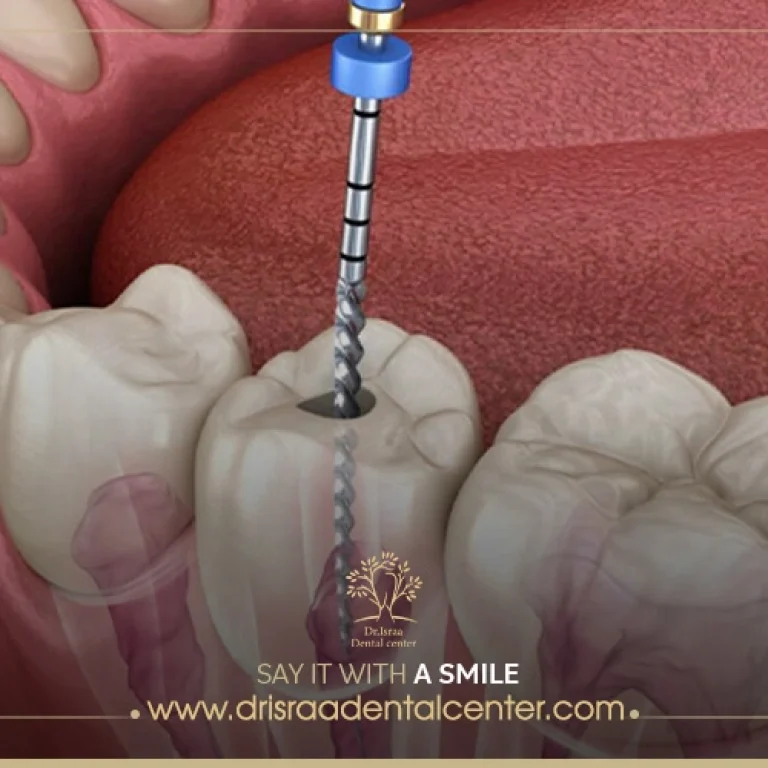 التهاب عصب الضرس