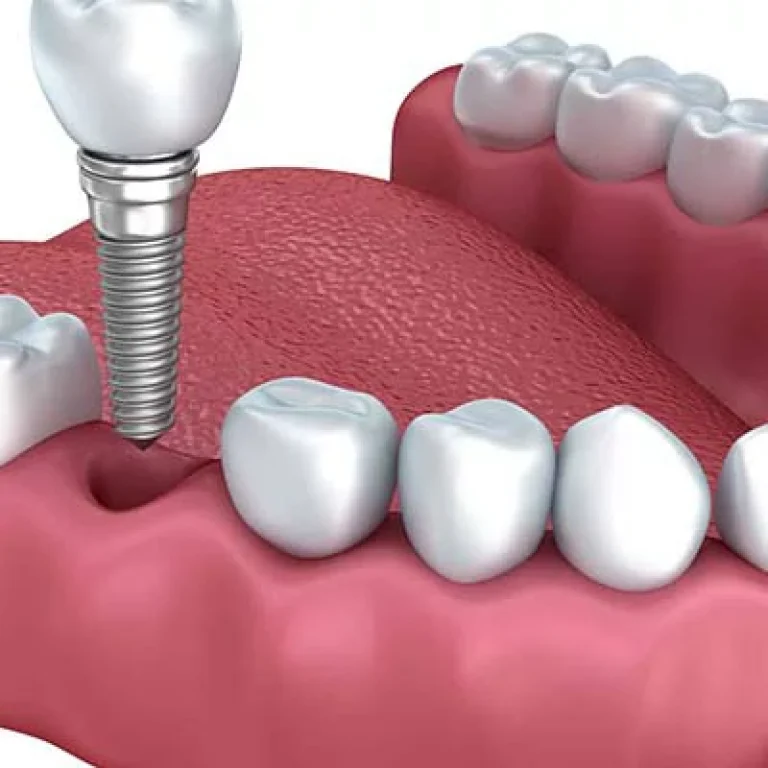 العمر الافتراضي لزراعة الاسنان