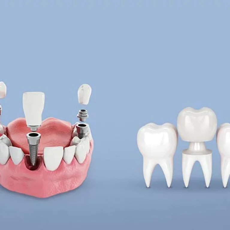 الفرق بين زراعة الاسنان وتركيب الاسنان