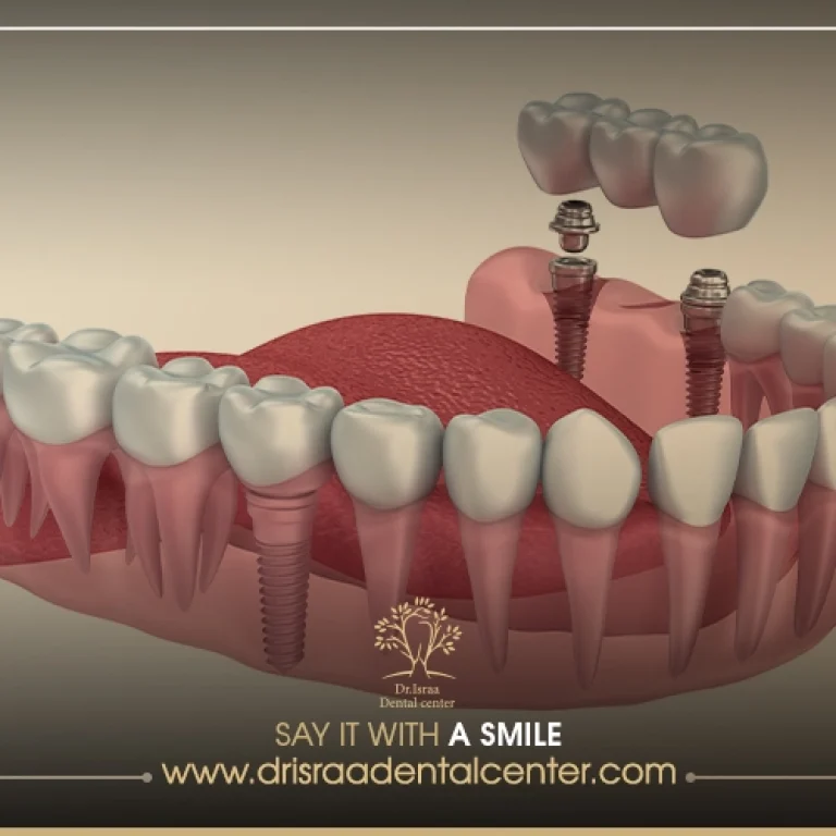 انواع تركيبات الاسنان