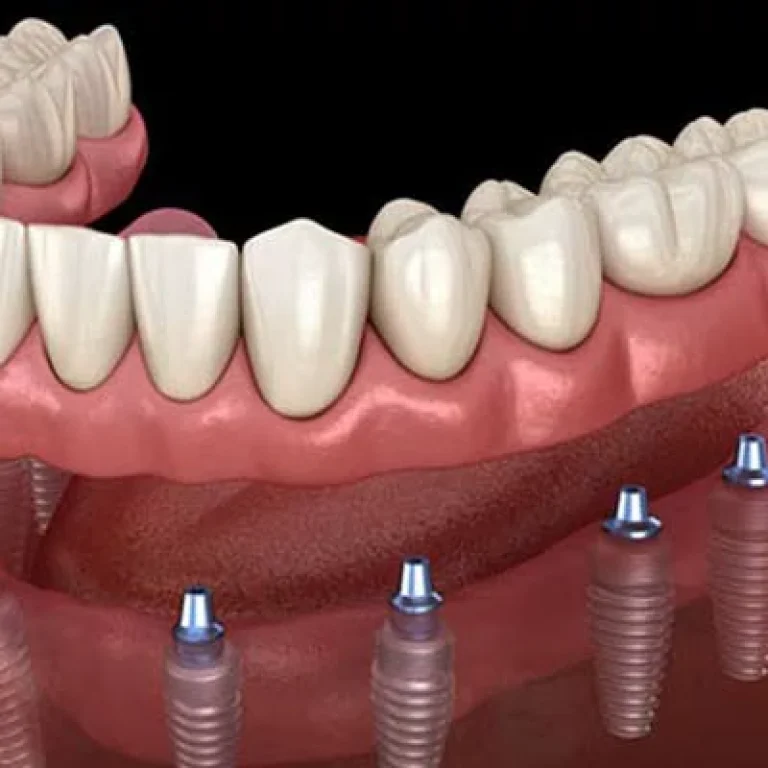 انواع زراعة الاسنان
