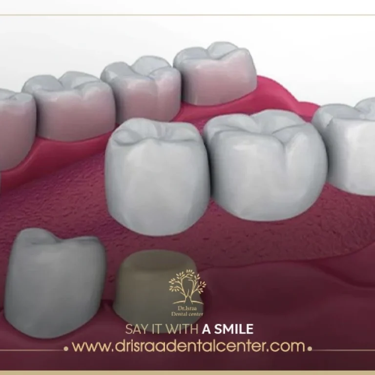 تجربتي مع جسر الاسنان