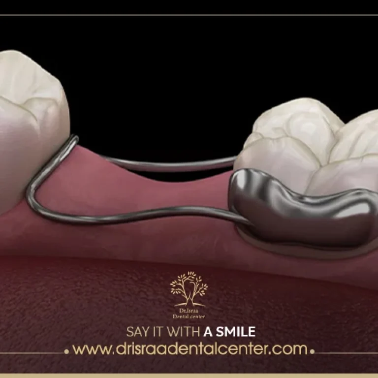 تركيب ضرس مكان المخلوع