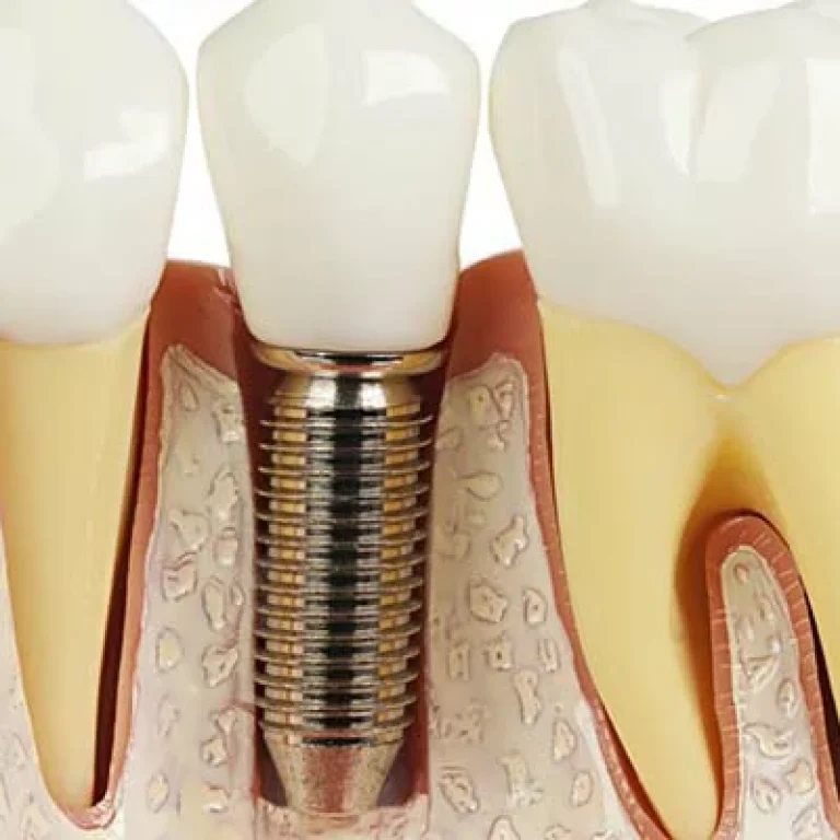 تكلفة زراعة الاسنان في مصر