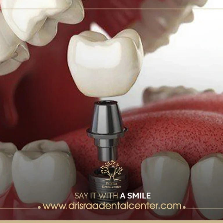 تكلفة زراعة الضرس الواحد