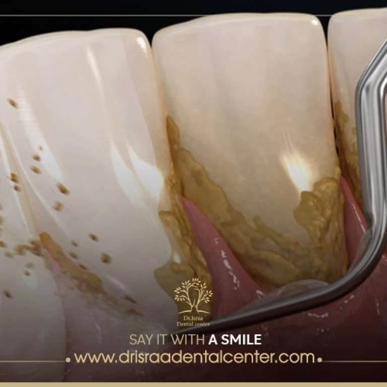 تنظيف الاسنان من الجير